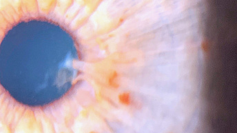 Заболевания глаз у детей с синдромом Дауна